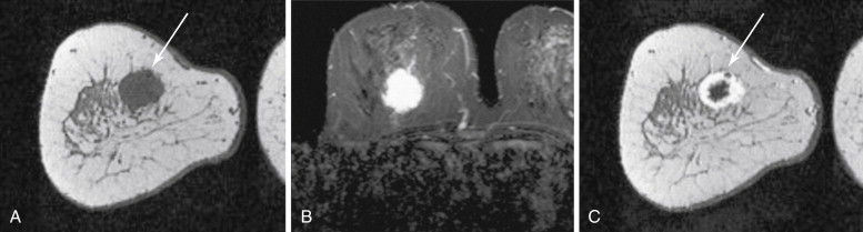 MR guided breast biopsy