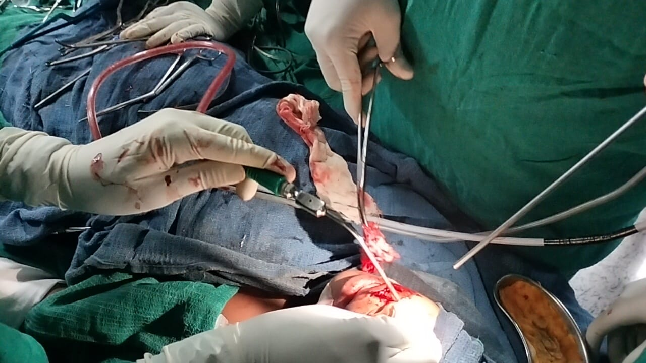 Anesthesia